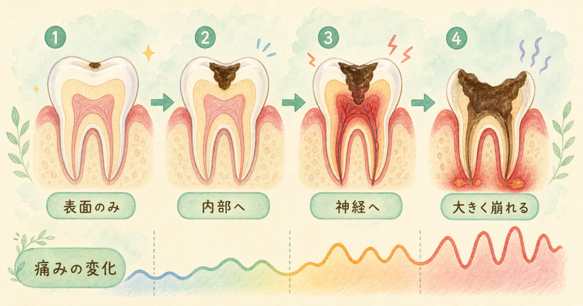 痛みが消えたむし歯を放置するリスクと進行段階（C1〜C4）の目安