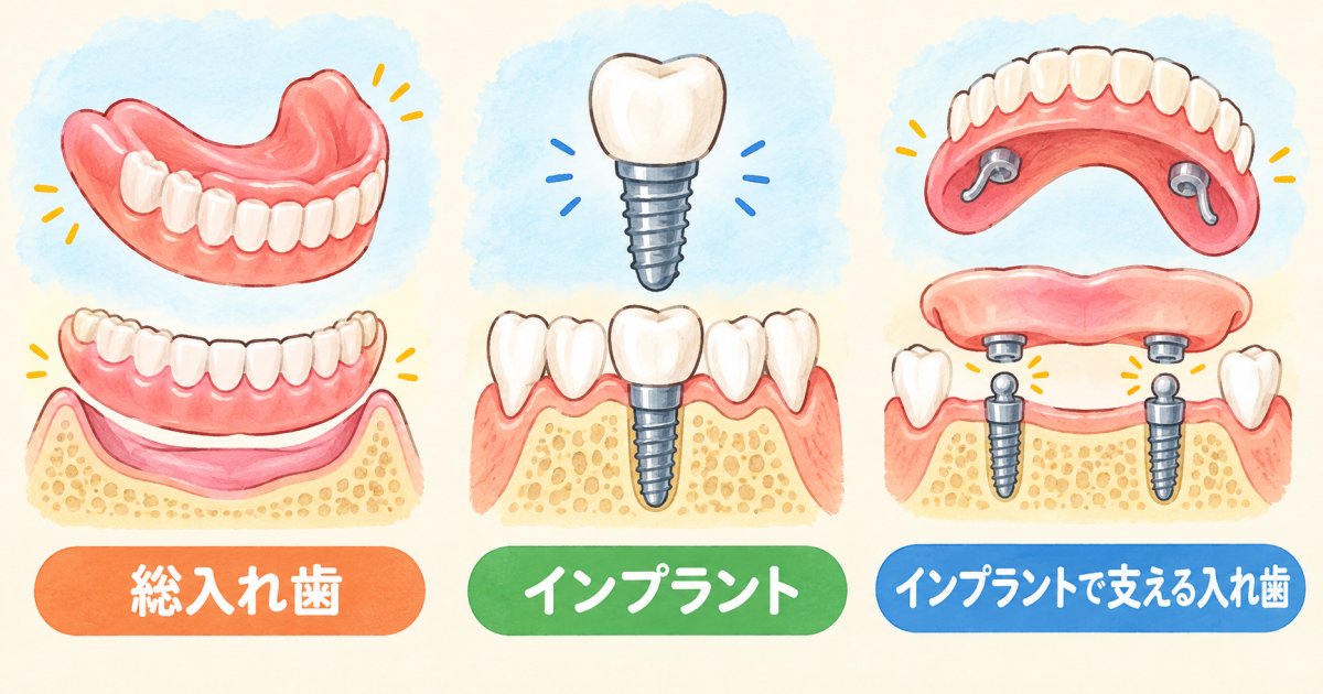 すべての歯を失った場合の治療選択肢とそれぞれの特徴