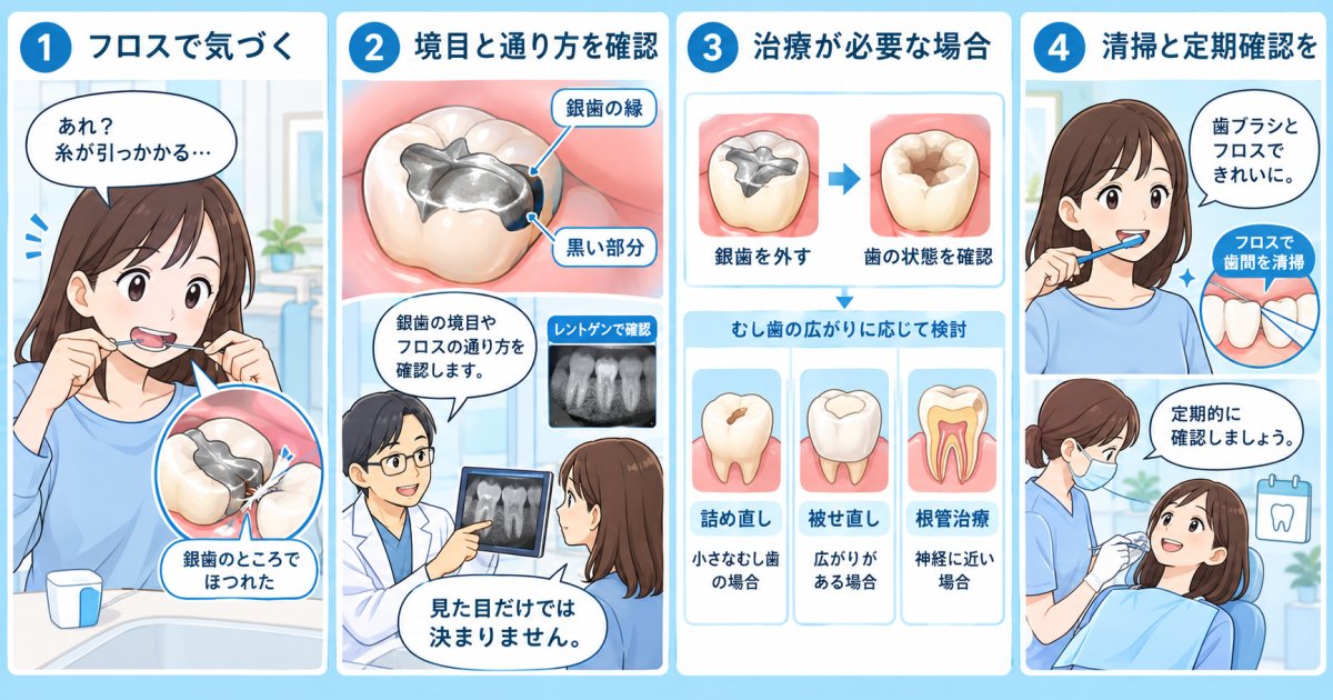 銀歯の縁が黒い・フロスが引っかかる｜むし歯の可能性と受診目安