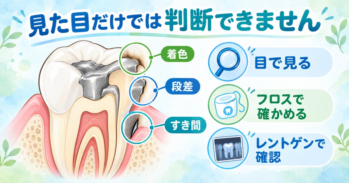 銀歯の縁が黒い・フロスが引っかかるとき、どう受診を判断する？